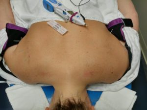 Dry Needling Therapy in Maryland